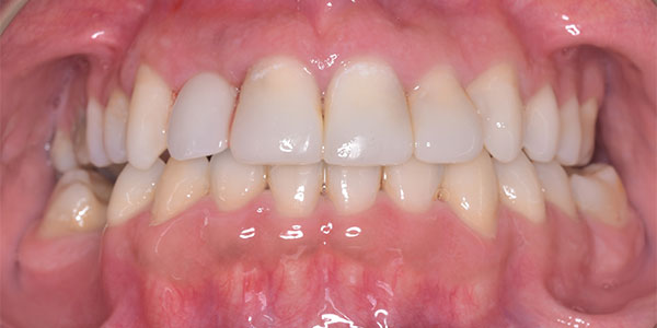 After the treatment which involved composite bonding and teeth whitening our patient's smile gave him more confidence.